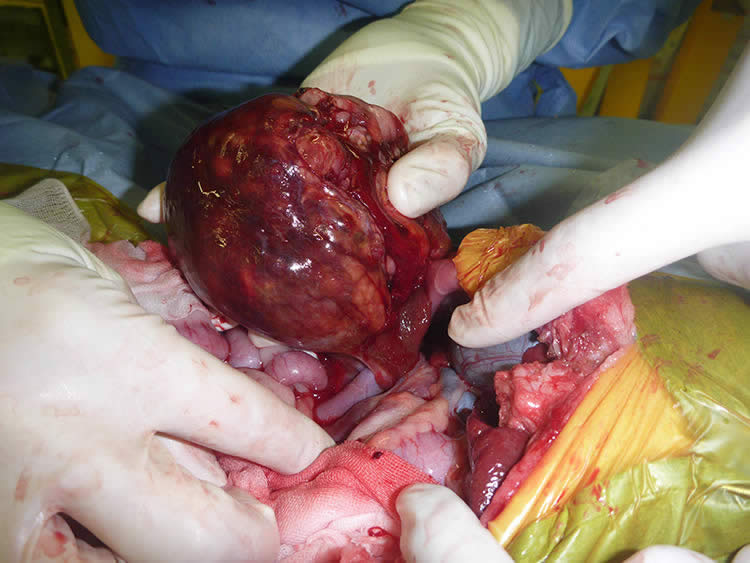 肝臓腫瘍の外観